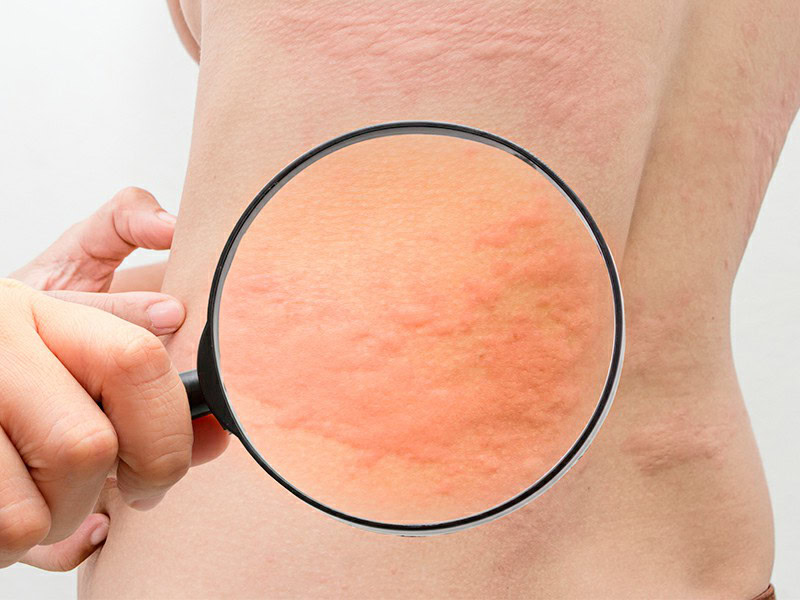 Urticaria | Dicas de Saúde