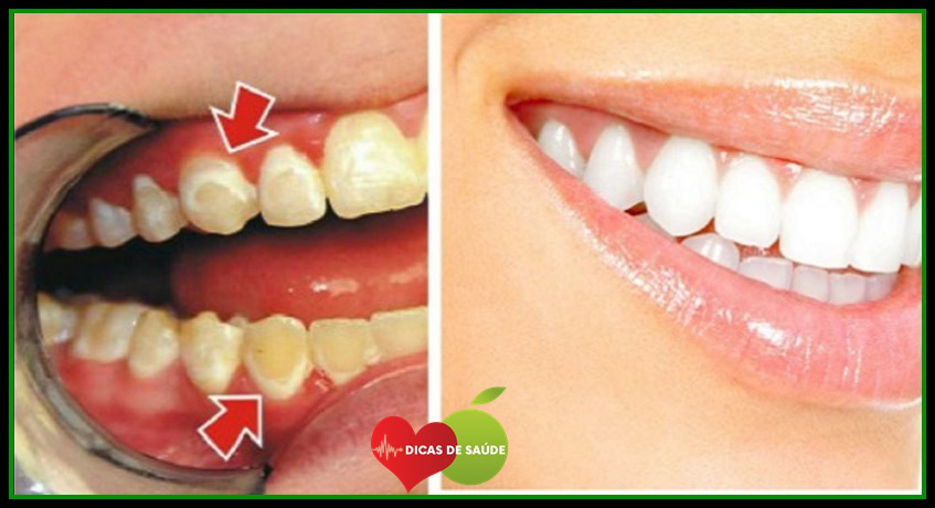 Esta Simples Receita ELIMINA AS CÁRIES em Apenas 2 MINUTOS | Dicas de Saúde Esta Simples Receita ELIMINA AS CÁRIES em Apenas 2 MINUTOS