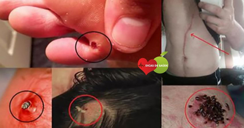 Os 10 Sinais que seu Corpo Está Cheio de Pragas | Dicas de Saúde
