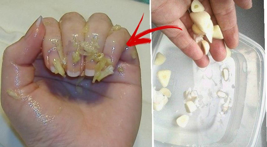 alho para eliminar os fungos das unhas | Dicas de Saúde alho para eliminar os fungos das unhas