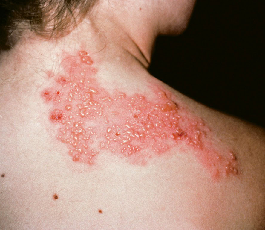 Herpes Zoster | Dicas de Saúde Herpes Zoster