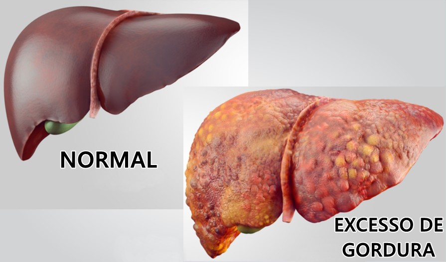 como eliminar a gordura do fígado | Dicas de Saúde como eliminar a gordura do fígado