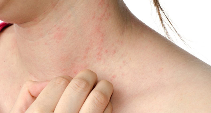 maneiras de como eliminar a alergia | Dicas de Saúde maneiras de como eliminar a alergia