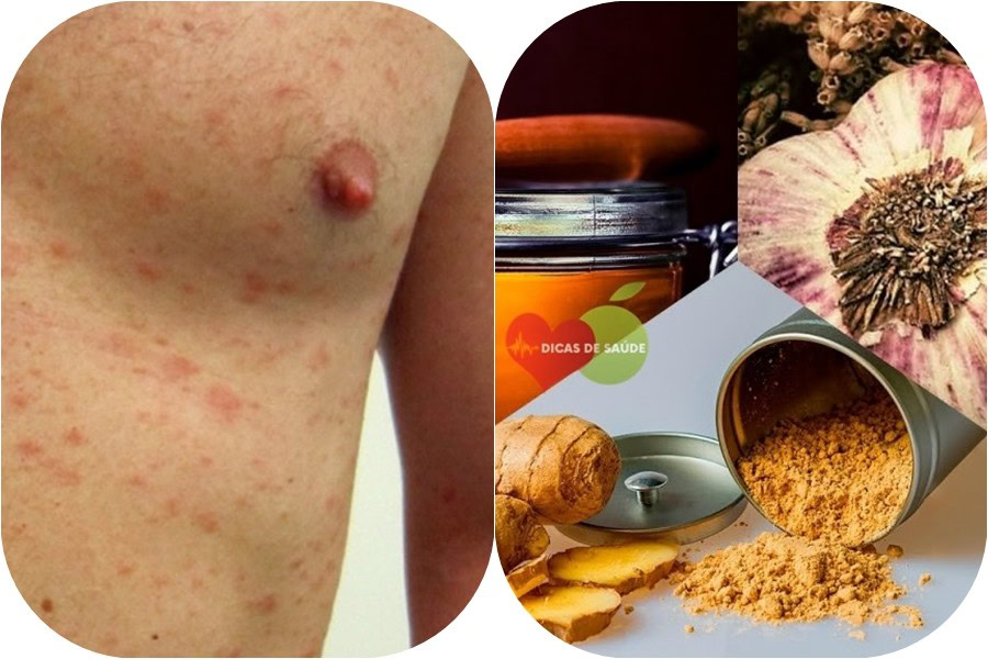 Remédio Natural Para Eliminar as Infecções no Corpo | Dicas de Saúde Eliminar as Infecções no Corpo