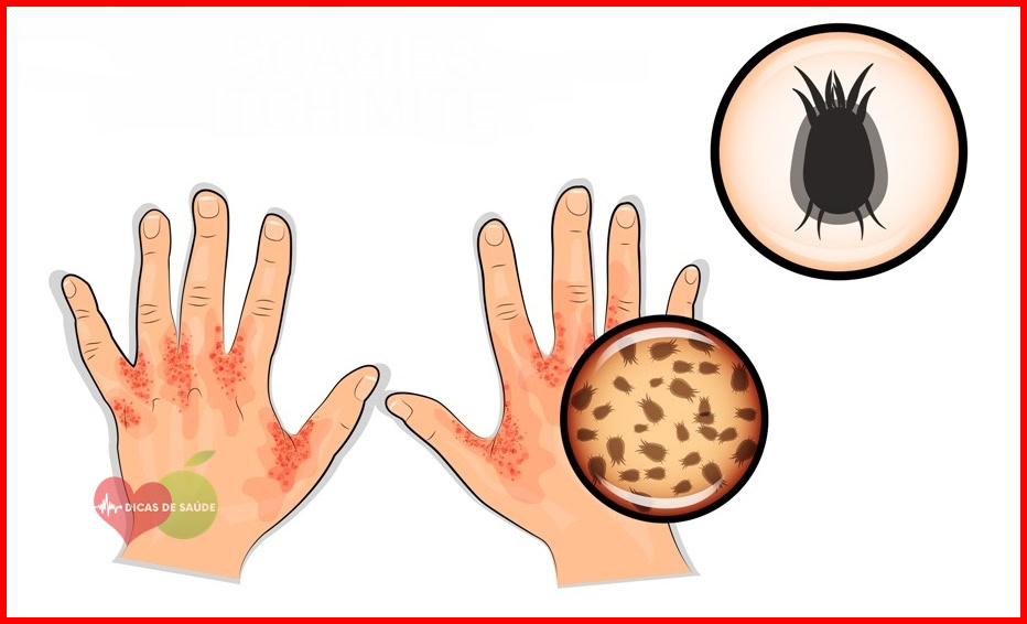 As 10 Soluções Naturais Para o Tratamento da Sarna | Dicas de Saúde As 10 Soluções Naturais Para o Tratamento da Sarna