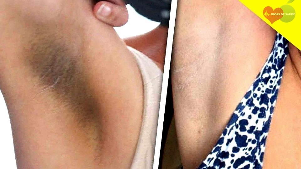 Elimine as Toxinas de Desodorante da Sua Axila em Um Dia | Dicas de Saúde
