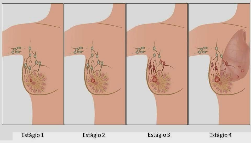 doença paget | Dicas de Saúde doença paget