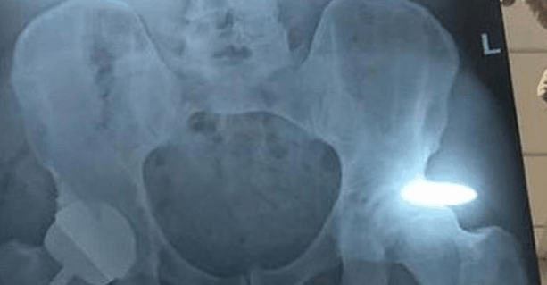 Andy Murray Undergoes Hip Surgery Andy Murray Undergoes Hip Surgery