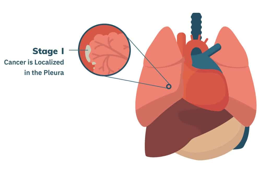Stage 1 Mesothelioma | Treatment Options and Prognosis
