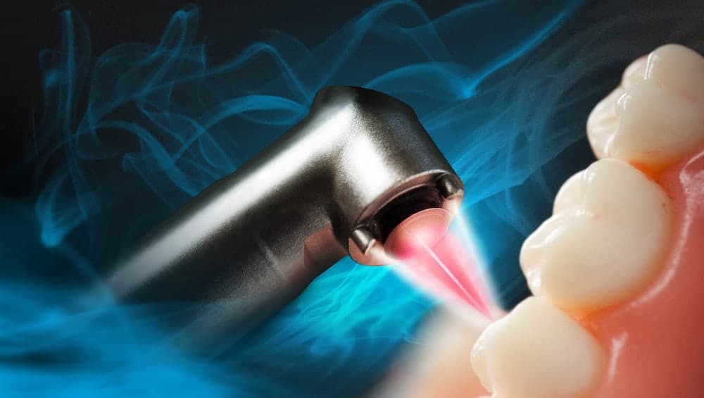 Waterlase Laser Dentistry Dr. Suffoletta