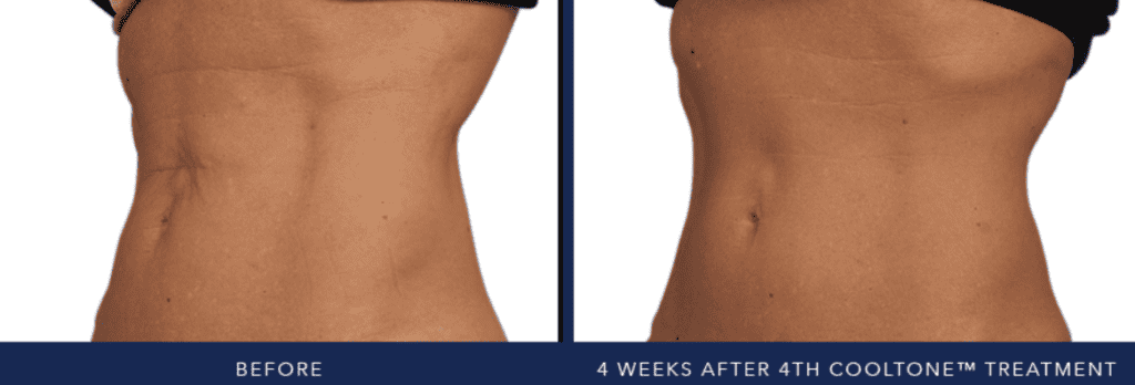 CoolTone before and after
