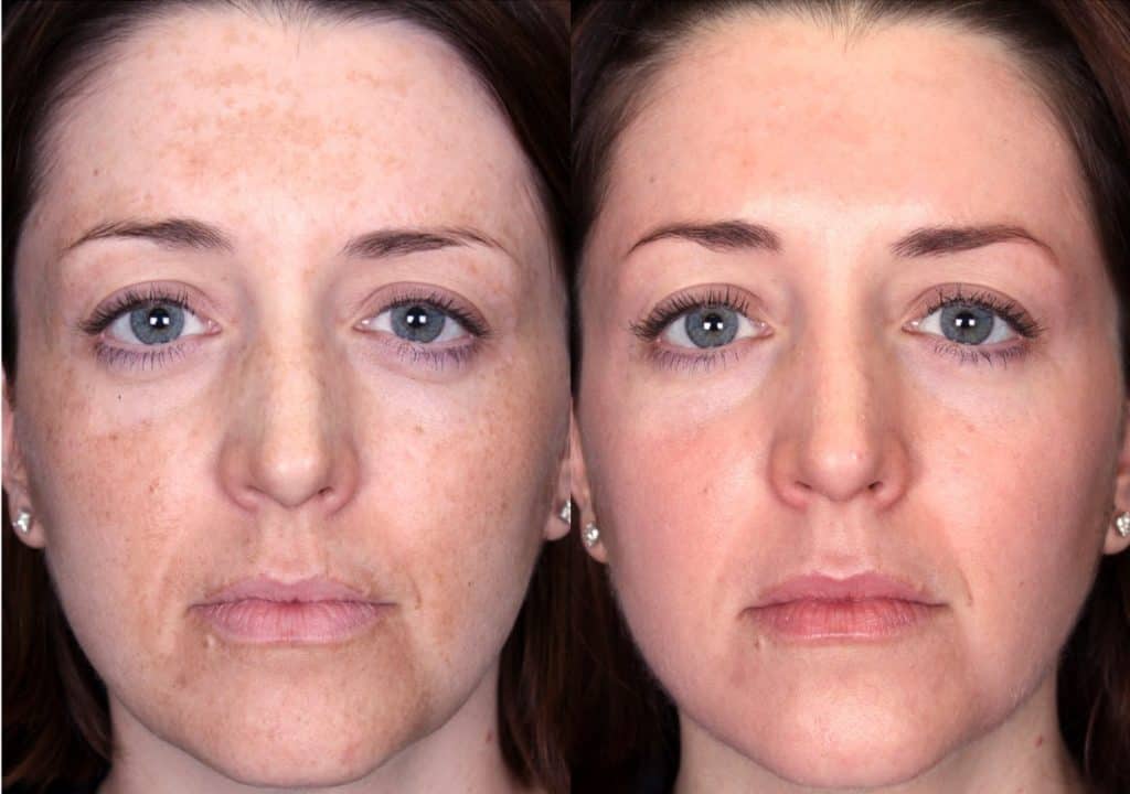 antes y después de la corriente galvánica facial