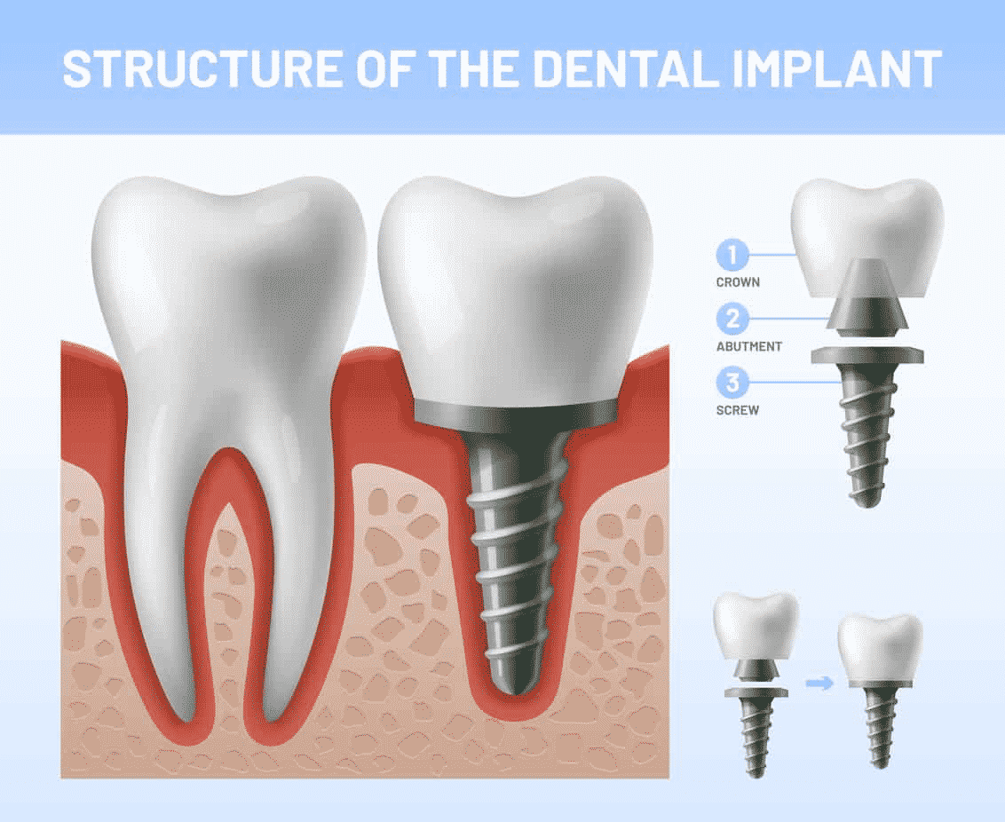 dental implant new dental implant new