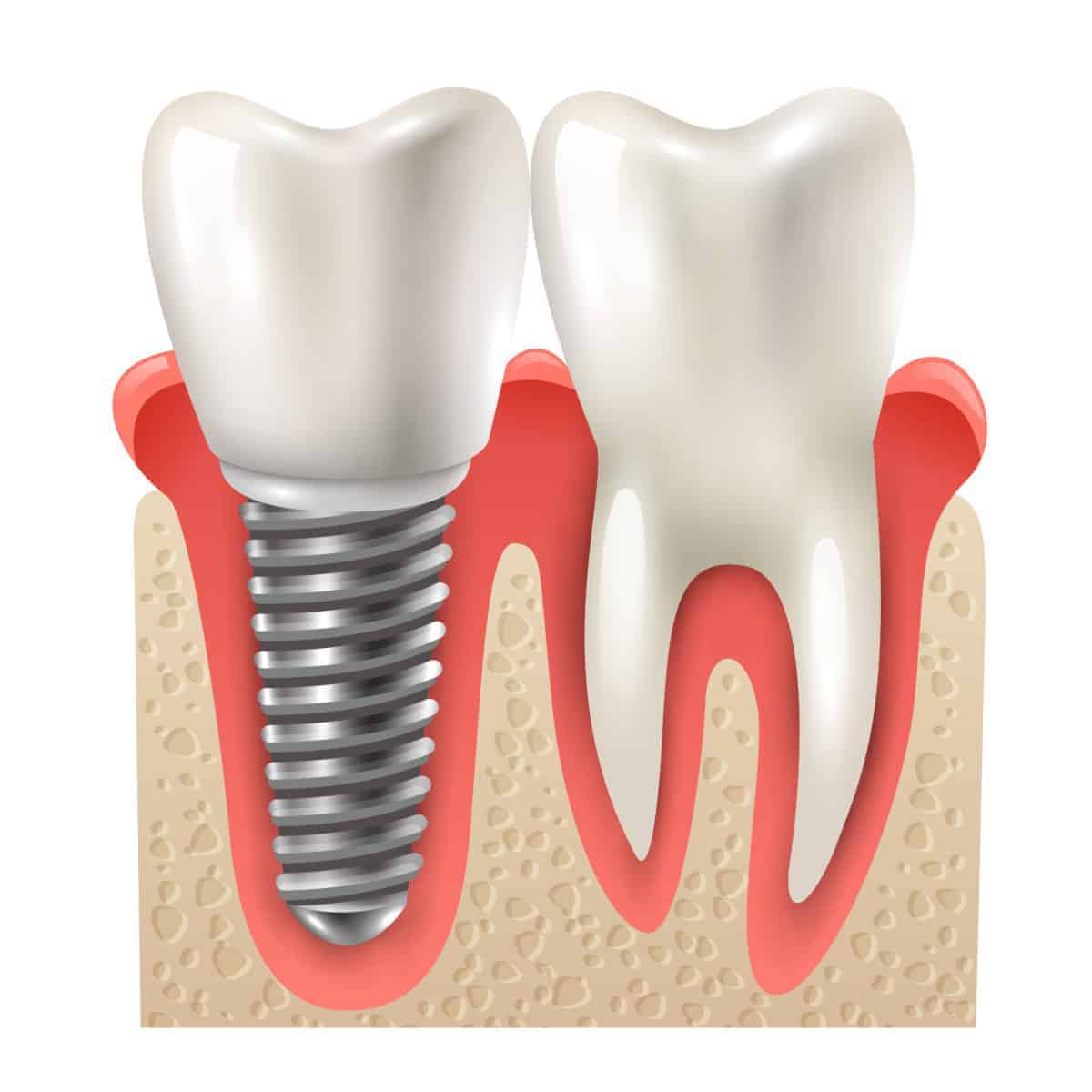 1609.i107.031.p.m005.c23.dental implant set