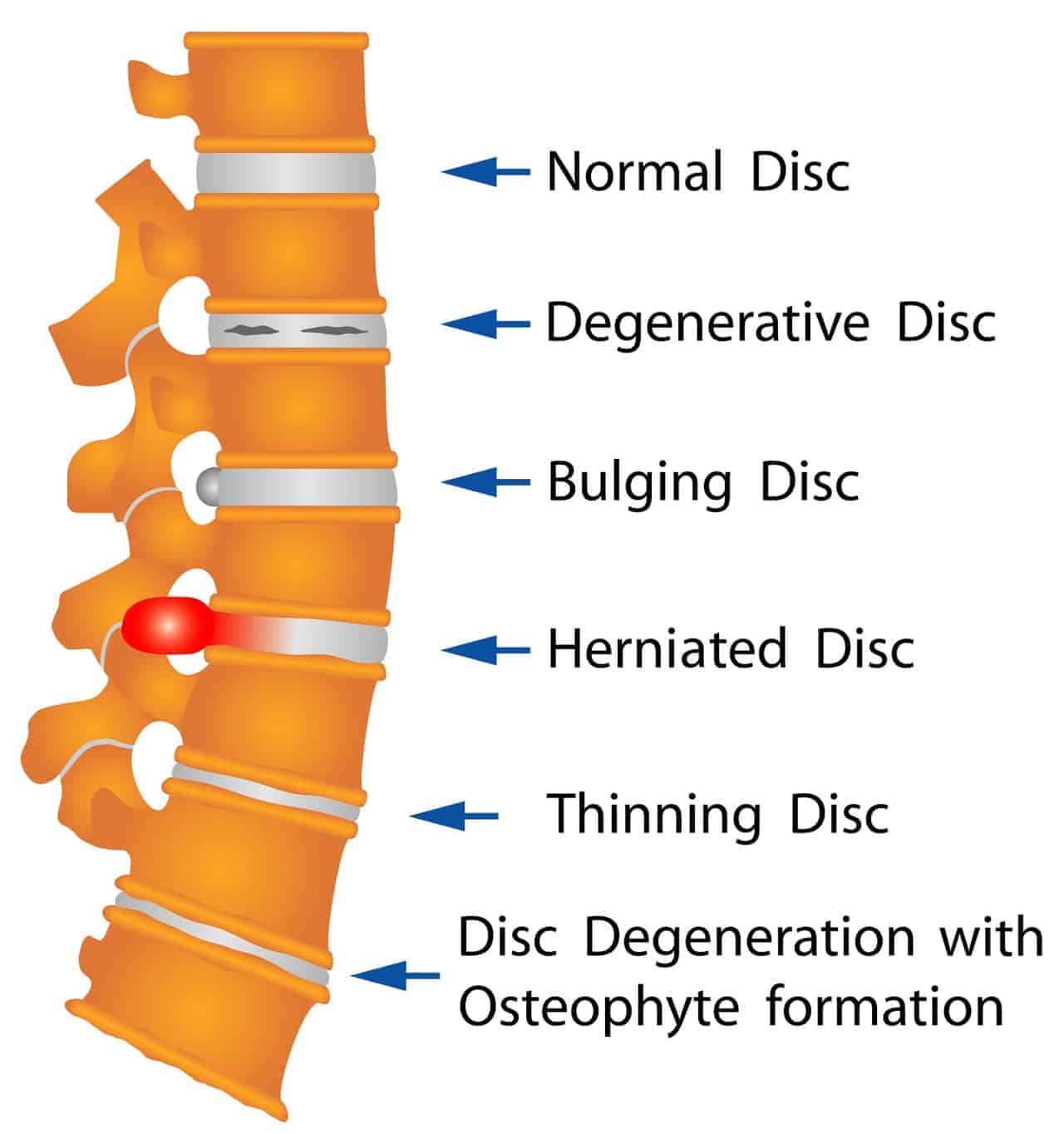 Spine Back Pain. Chronic Back Pain. Perception of Pain