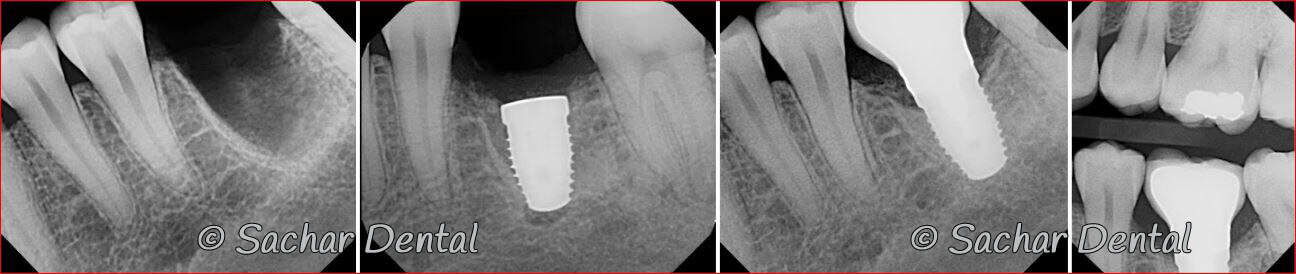Dental implant NYC Picture of Before and after x-rays of tooth extraction and dental implant plus bone graft