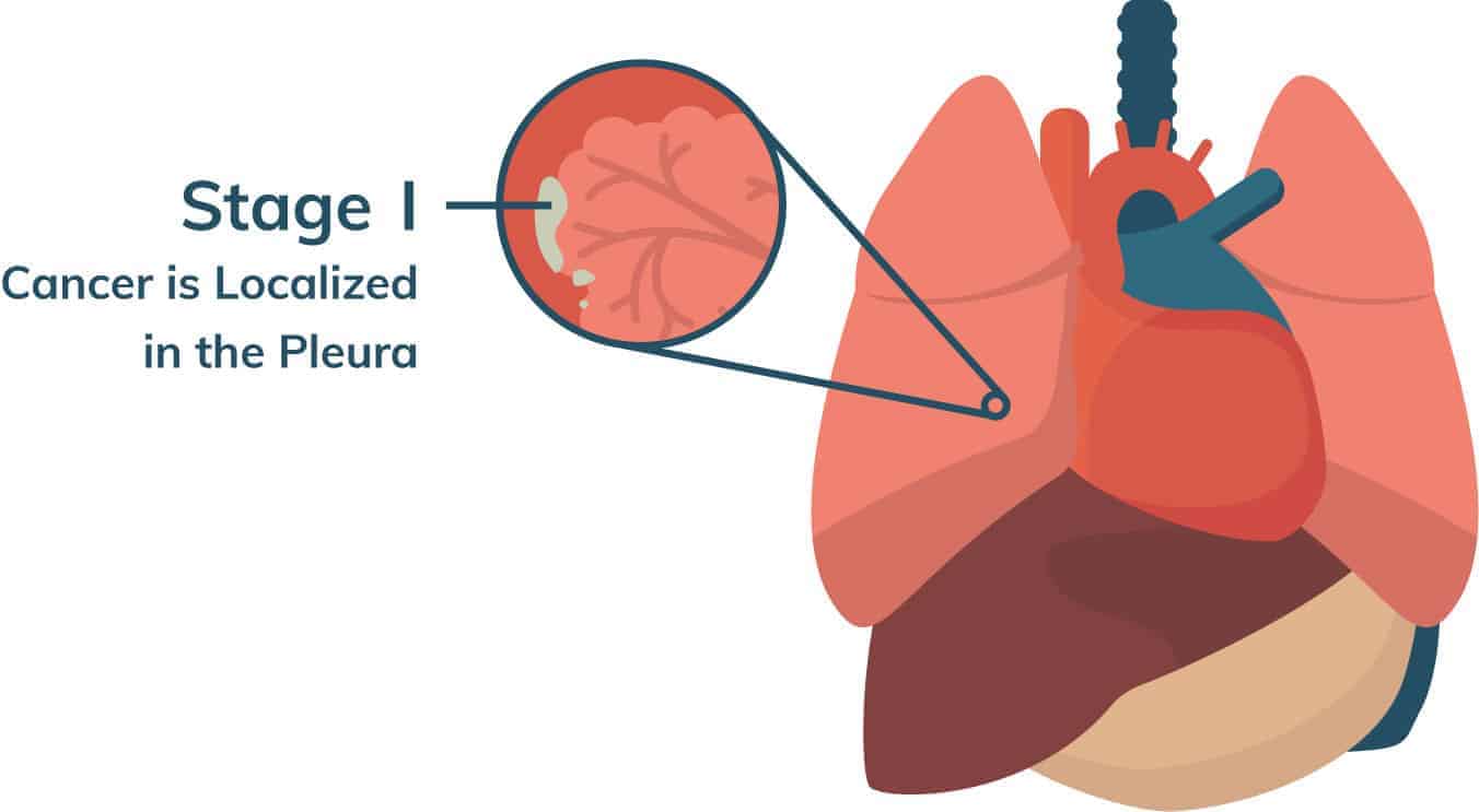 Malignant Mesothelioma Cancer | Stages, Prognosis, Treatment