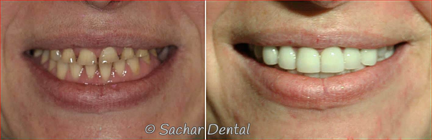 dental implants crowns full mouth reconstruction nyc Cosmetic Dentistry NYC