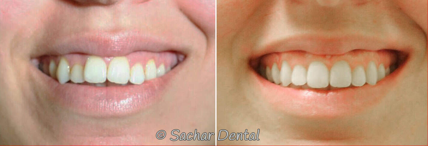 NYC Invisalign Invisalign NYC