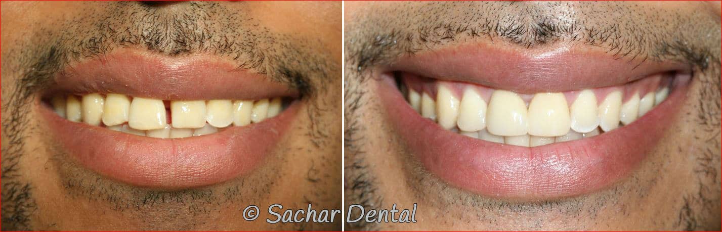crown veneer dental bonding Top Manhattan Cosmetic Dentists