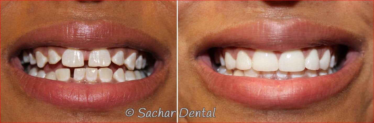 porcelain veneers dental bonding Porcelain Veneers NYC