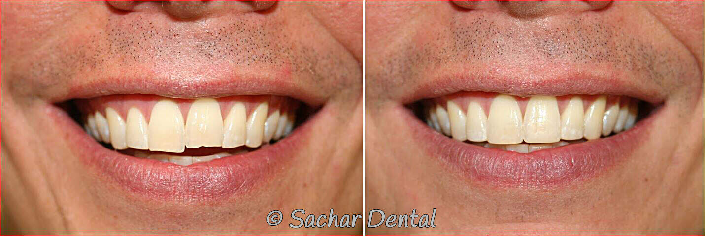 tooth bonding nyc Before and after pictures of resin bonding of chipped teeth