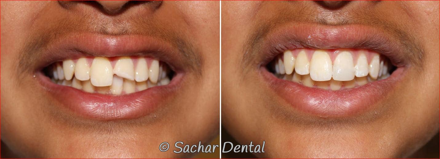 dental bonding NYC Cosmetic Dentist NYC, Before and after pictures
