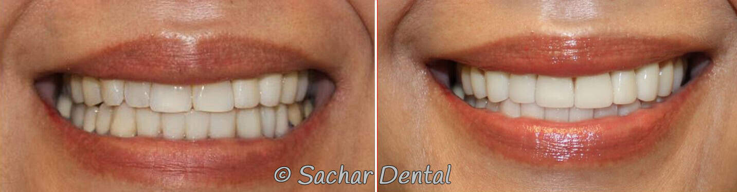 teeth bleaching crown porcelain veneers bridge Before and after pictures of porcelain veneers and a bridge