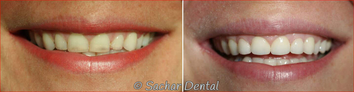 porcelain veneers Before and after pictures of porcelain veneers