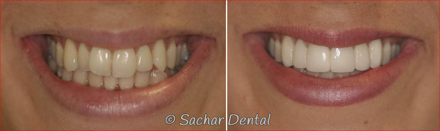 Best Dentist NYC Porcelain Veneers NYC
