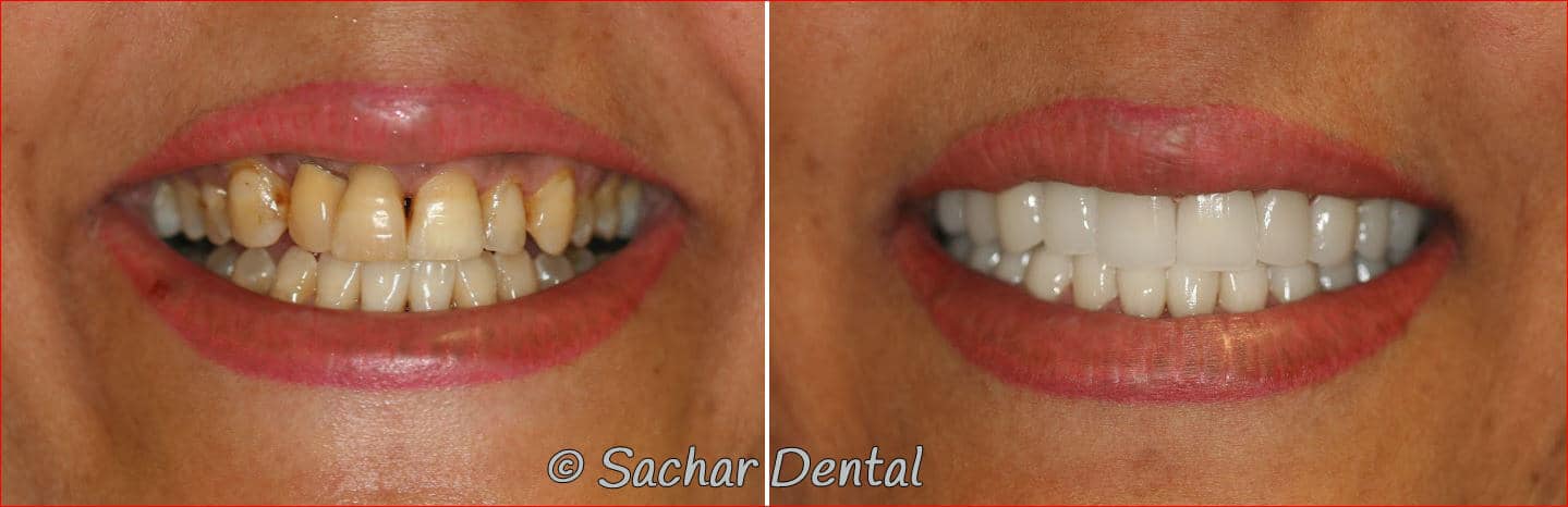 Cosmetic Dentist NYC / Sachar Dental Best Cosmetic Dentist NYC.