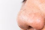 Homemade face mask for blackheads