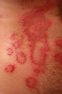 psoriasis