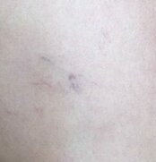 Varices