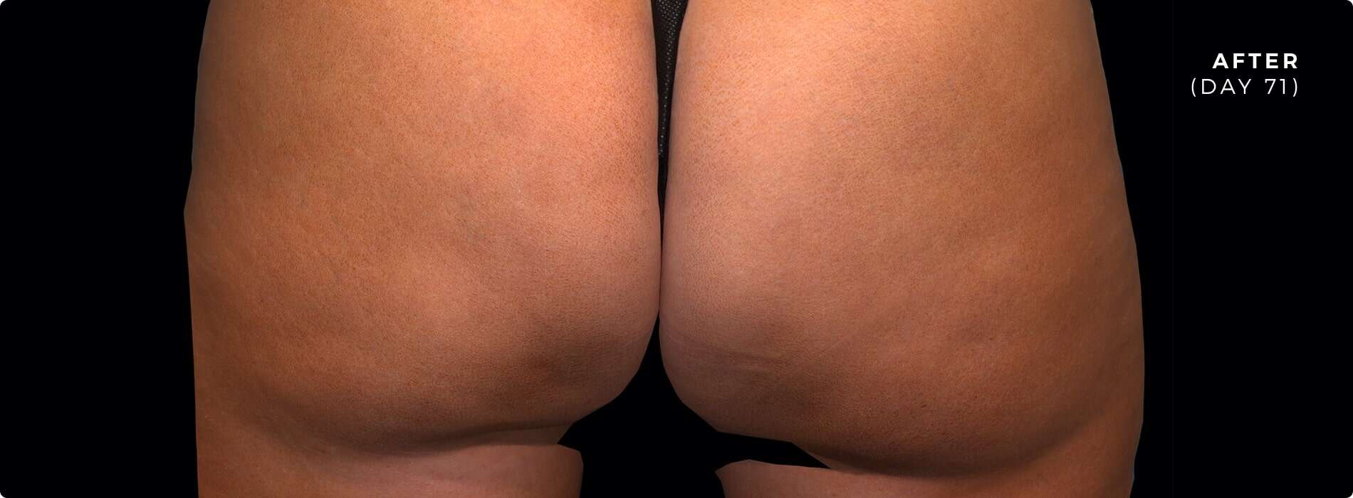 desktop-ba-slider-patient-1-after@2x-min 71 days after QWO for cellulite
