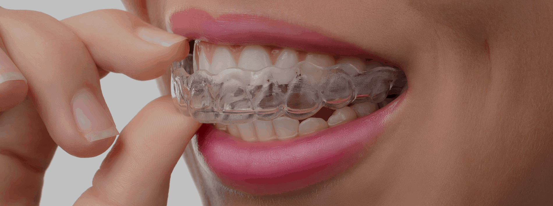 Orthodontics Clear Aligners over Braces