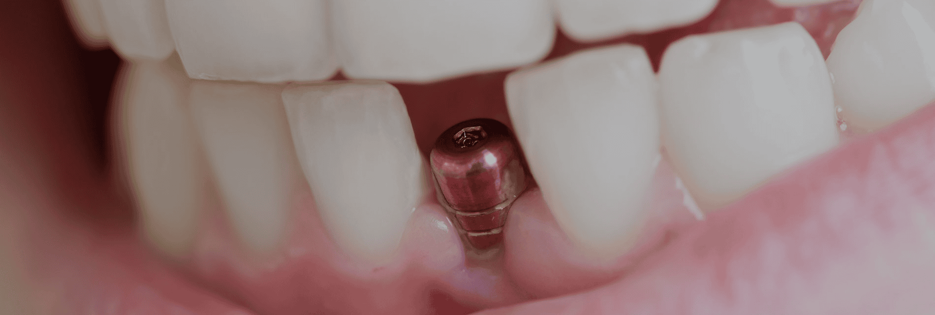 Dental Implants Page