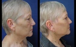 Skin tightening Dana Point