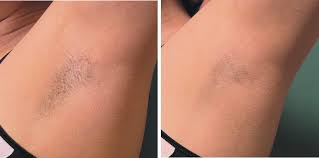 antes y despues laser diodo