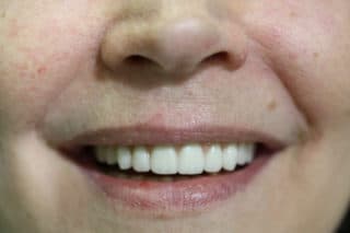 full mouth2 320x213 full mouth2 320x213
