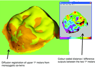 This 3D mapping overlay shows the difference in tooth shape and surface area between a pair of identical twins, demonstrating that factors other than genetics help determine tooth topography. Figure: Yong et al., 2014.