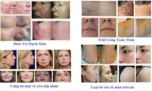 Hiệu Quả Sử Dụng Máy triệt Lông HS 965 Trước Và Sau Khi Sử Dụng Máy Triệt Lông APOLO HS 965