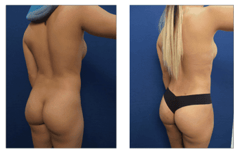 Brazilian Butt Lift Revision Before And After Dr Mowlavi