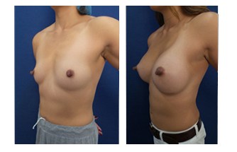 Breast Augmentation