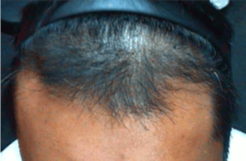 Pt_2_After_6_KL_360x After 6 KeraLase Treatments (12 Weeks)