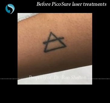 Reveal Your Best Skin With Picosure Focus Treatment Anna Avaliani Md Cosmetic Laser Surgery