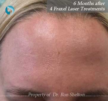 6 months after 4 fraxel lasers