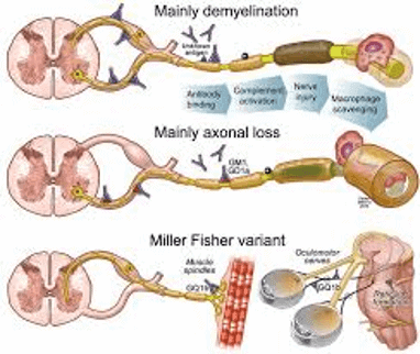 Catatan Koas2doctor Guillain Barre Syndrome Update Koas2doctor