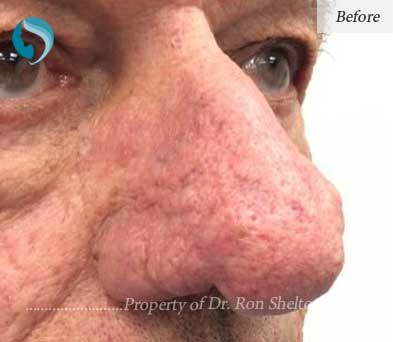 Before Laser Resurfacing
