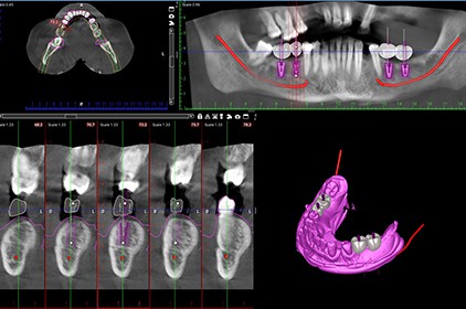 Digital implantologi6